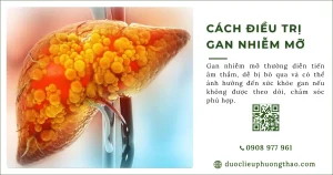 Cách điều trị gan nhiễm mỡ cần chú ý những gì?