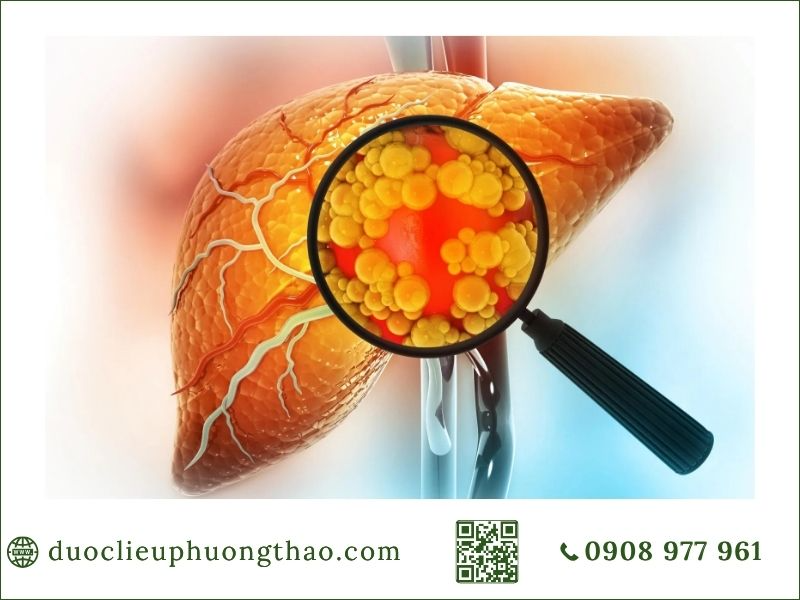 nguyên nhân gan nhiễm mỡ