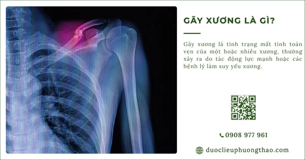 Gãy xương là gì? Nguyên nhân, dấu hiệu, cách xử lý ở người trung niên