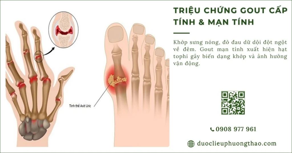 Triệu chứng gout cấp tính, dấu hiệu nhận biết sớm của bệnh gout cấp tính và mạn tính là gì?