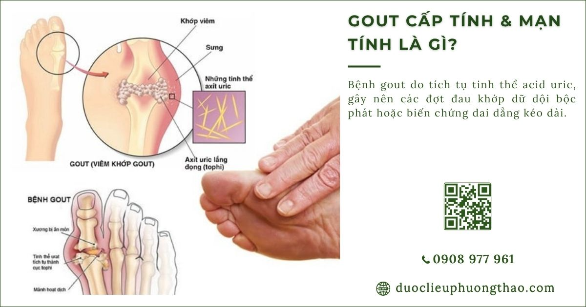 gout cấp tính là gì