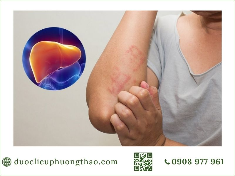 Men gan cao là gì? Nguyên nhân, triệu chứng và Cách phòng tránh như thế nào? Men gan cao gây ngứa da, mẩn ngứa? Dấu hiệu cảnh báo gan đang bị tổn thương