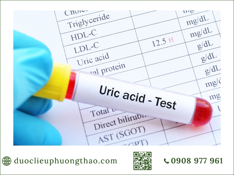 Xét nghiệm chỉ số axit uric máu giúp xác định nguyên nhân tăng axit uric