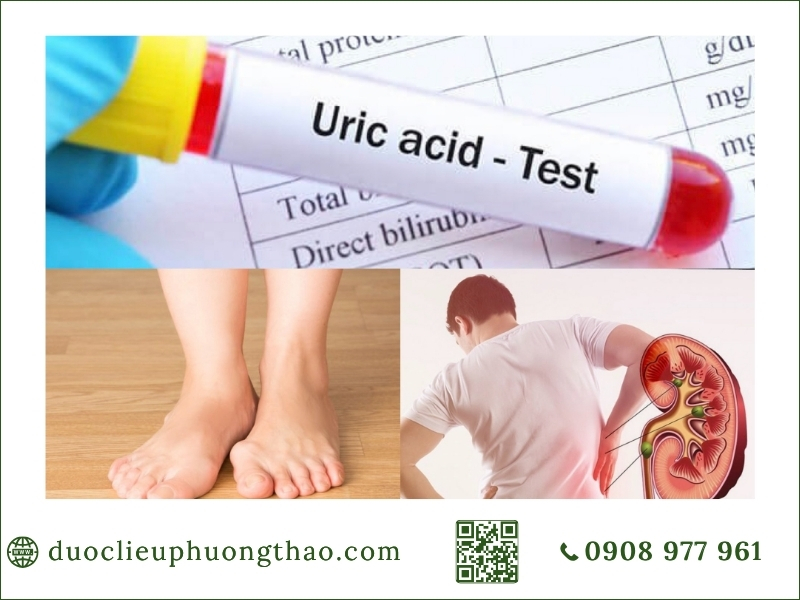 Xét nghiệm chỉ số axit uric máu hỗ trợ chẩn đoán và kiểm soát cơn đau gout