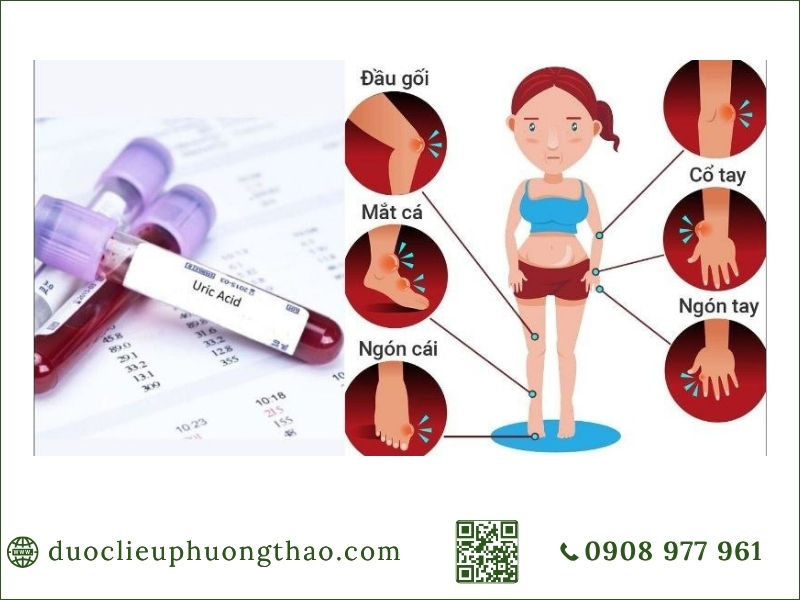 Tăng axit uric máu gây đau khớp ở đâu? 