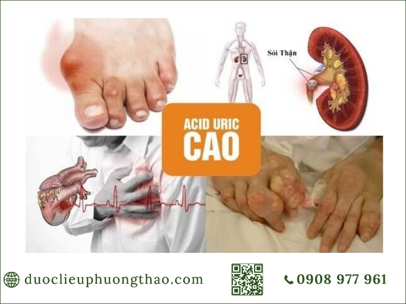 tình trạng tăng axit uric máu và nguy cơ gout, sỏi thận
