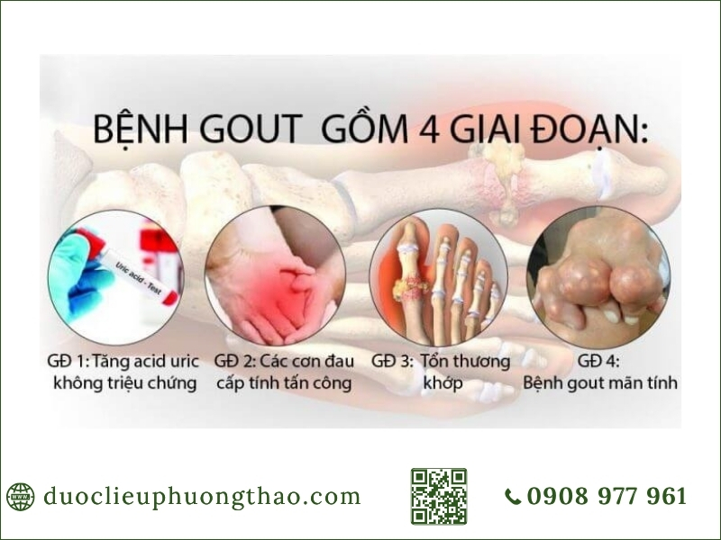 nguyên nhân gout cấp tính