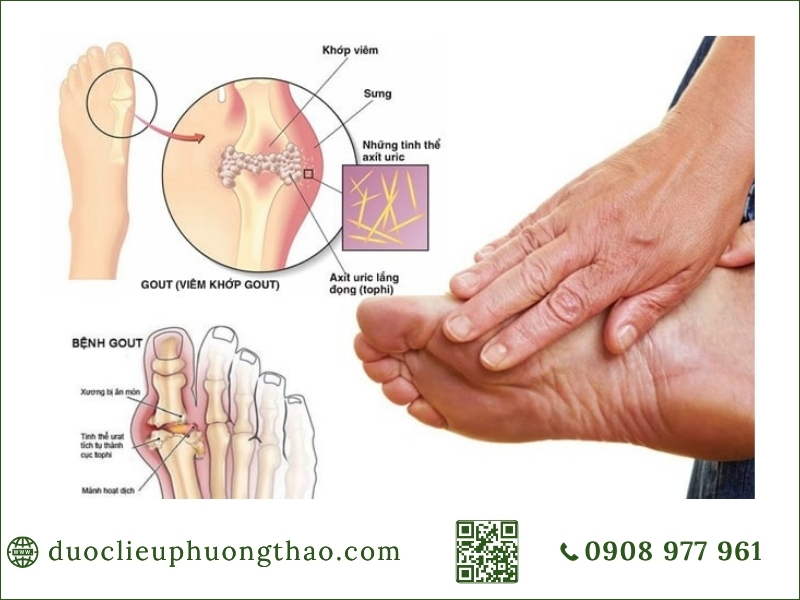gout cấp tính là gì