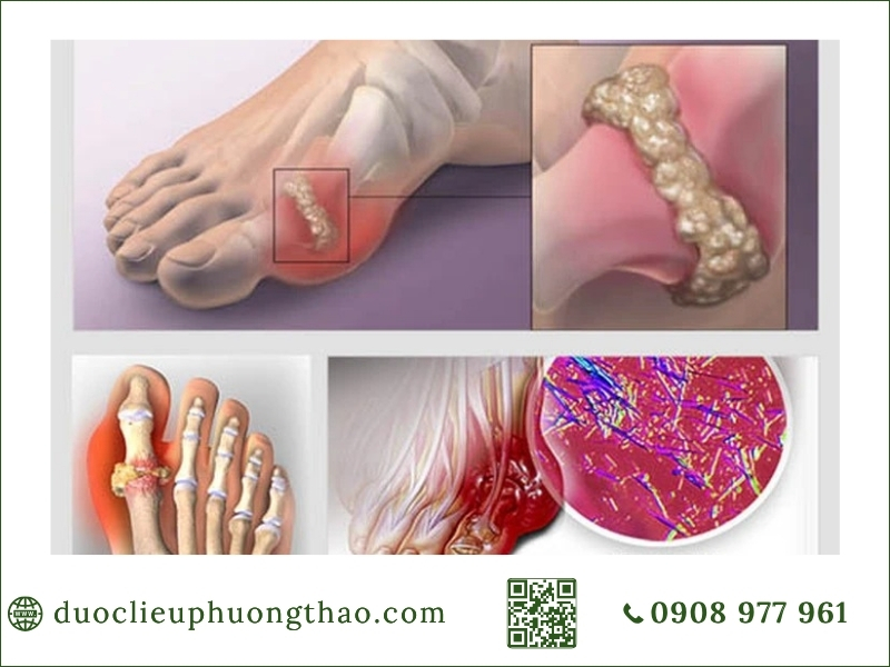 Các dạng tổn thương khớp và tinh thể urat điển hình để phòng tránh gout cấp tính