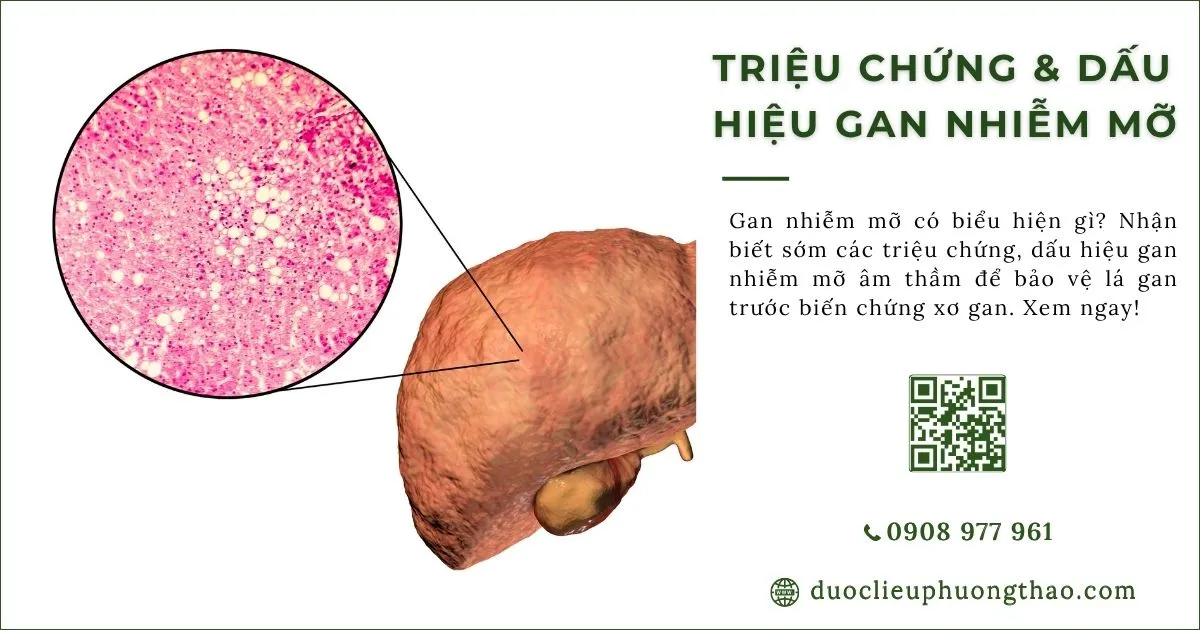 triệu chứng gan nhiễm mỡ