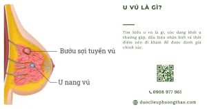 U vú là gì? Nguyên nhân, triệu chứng và cách xử trí an toàn cho chị em phụ nữ