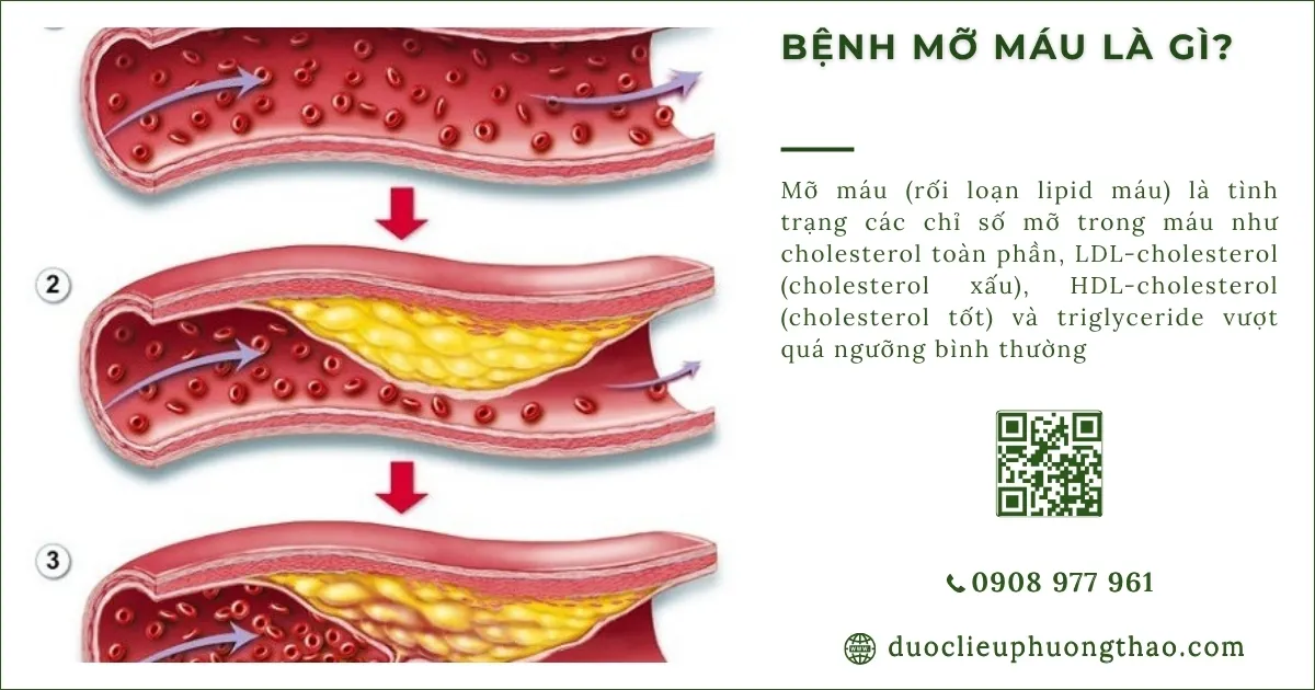 mỡ máu là gì