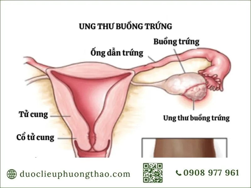 Ung thư buồng trứng là gì? Nguyên nhân, dấu hiệu và cách điều trị Vị trí ung thư buồng trứng trong cơ quan sinh sản