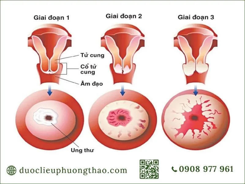 U buồng trứng là gì? Dấu hiệu, nguyên nhân và hướng xử trí phù hợp