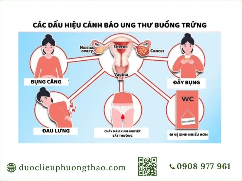 Ung thư buồng trứng là gì? Nguyên nhân, dấu hiệu và cách điều trị Nhận biết các dấu hiệu cảnh báo ung thư buồng trứng