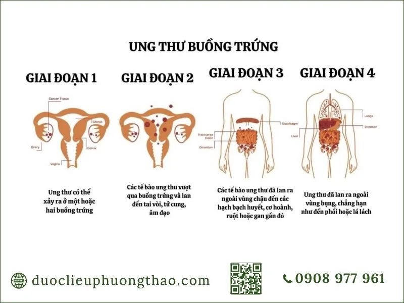 Ung thư buồng trứng là gì? Nguyên nhân, dấu hiệu và cách điều trị Các giai đoạn phát triển của ung thư buồng trứng