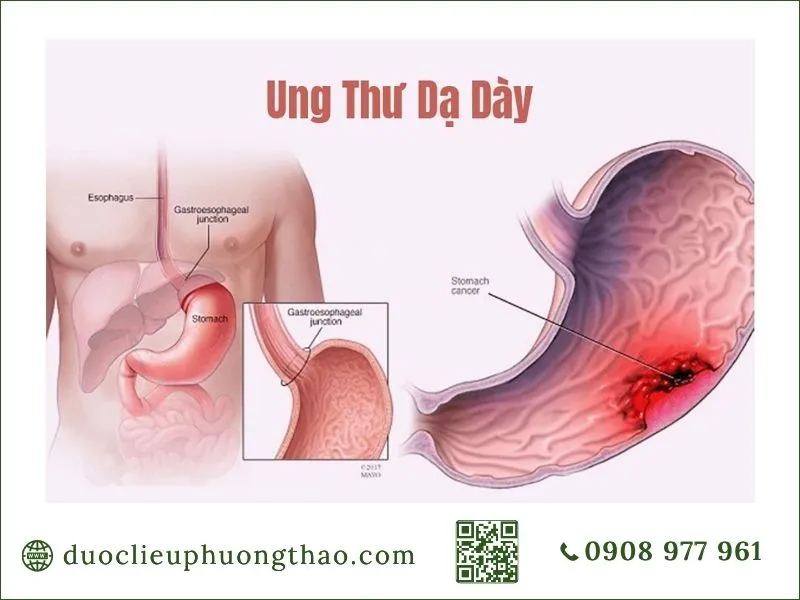 Vị trí ung thư dạ dày ở niêm mạc và thân dạ dày