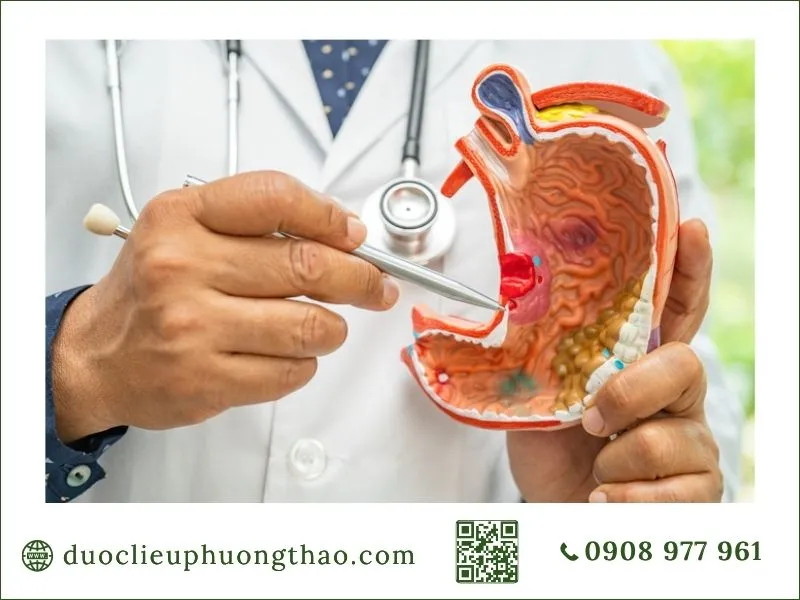 Mô hình mô phỏng cấu trúc và vị trí u dạ dày khi thăm khám