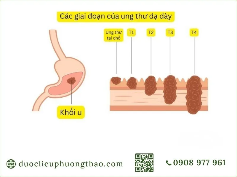 Các giai đoạn tiến triển của khối ung thư dạ dày từ T1 đến T4