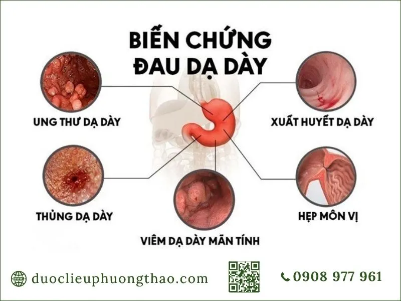 Các biến chứng u dạ dày gồm ung thư và xuất huyết