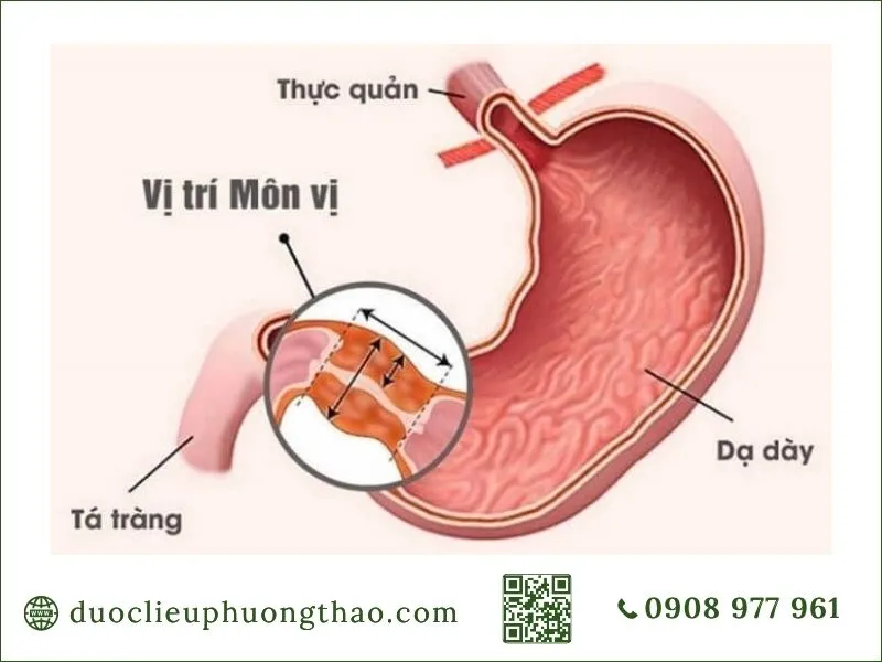 Vị trí môn vị trong cấu trúc dạ dày liên quan u dạ dày