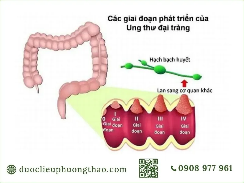 Ung thư đại tràng là gì? Nguyên nhân, triệu chứng và hướng xử lý cho người trung niên Các giai đoạn phát triển ung thư đại tràng từ giai đoạn 0 đến IV