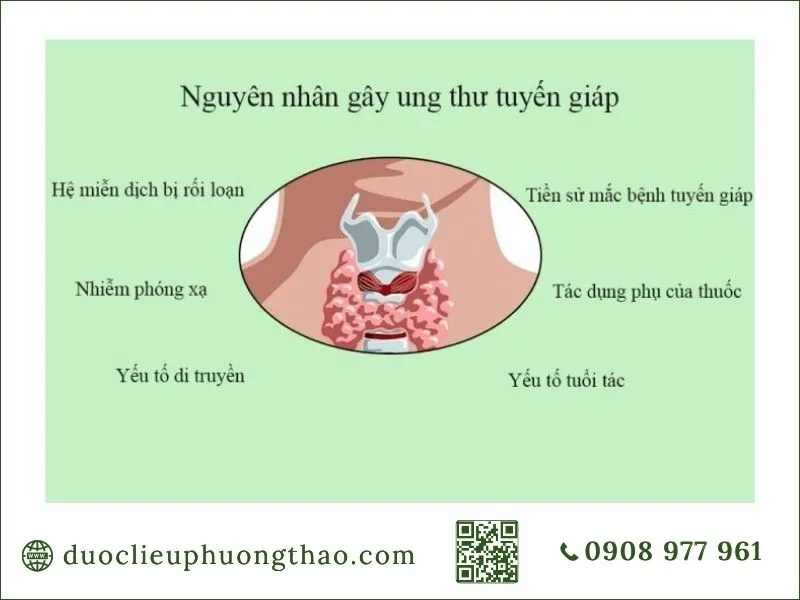 Ung thư tuyến giáp là gì? Nguyên nhân, triệu chứng và hướng điều trị phù hợp Sơ đồ các nguyên nhân và yếu tố nguy cơ gây ung thư tuyến giáp là gì