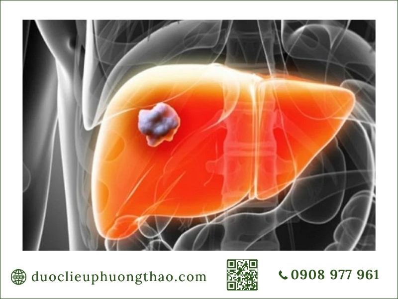 Vị trí u máu phát triển trong lá gan