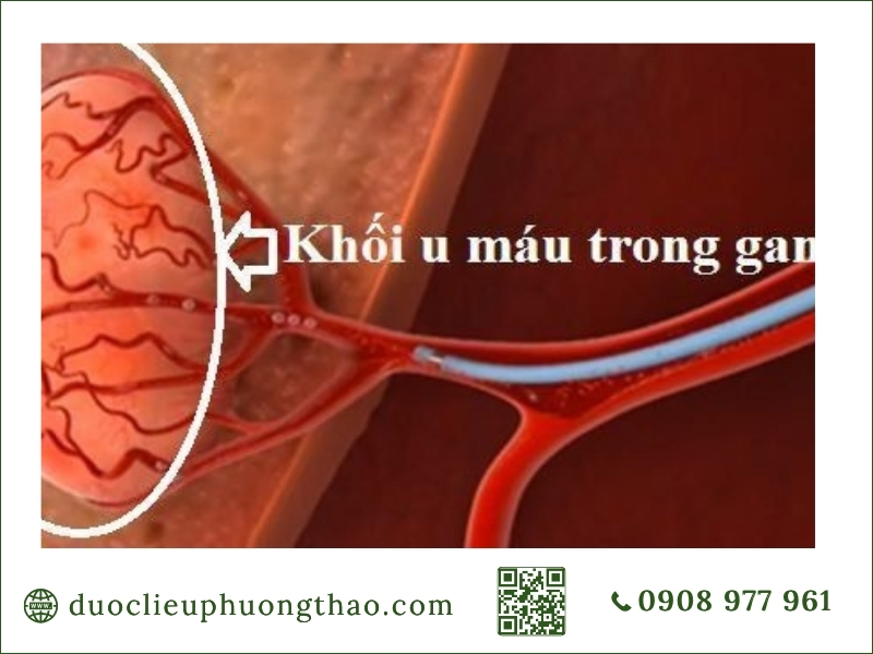 Sơ đồ vị trí và hình ảnh mô phỏng khối u máu trong gan