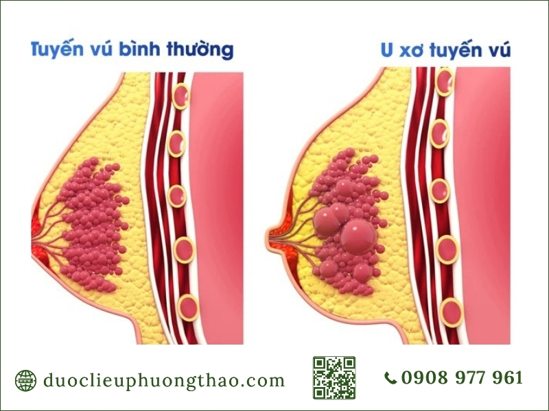 so sánh cấu trúc tuyến vú bình thường và u xơ tuyến vú