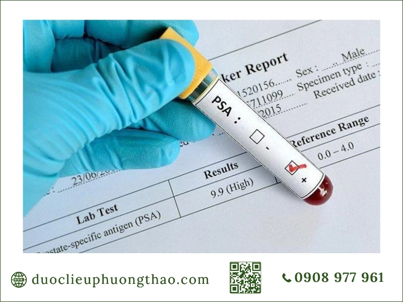 Xét nghiệm chỉ số PSA tầm soát ung thư tuyến tiền liệt