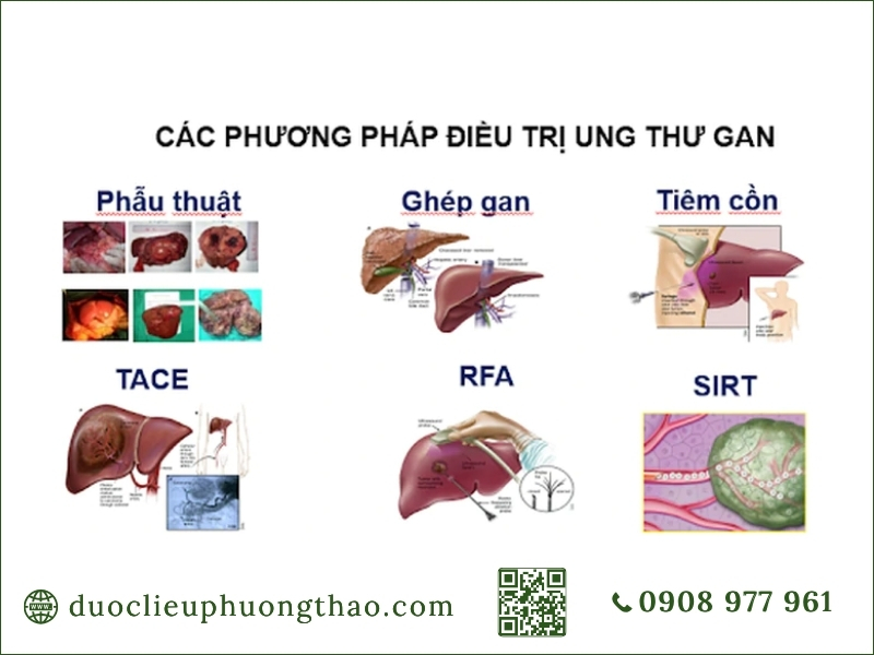 Tổng hợp các phương pháp điều trị ung thư gan phổ biến trong y khoa.