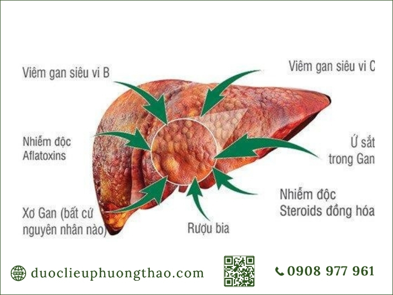 Các nguyên nhân hàng đầu làm tăng nguy cơ tổn thương và hình thành u gan là gì