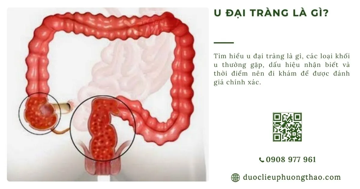 u đại tràng là gì