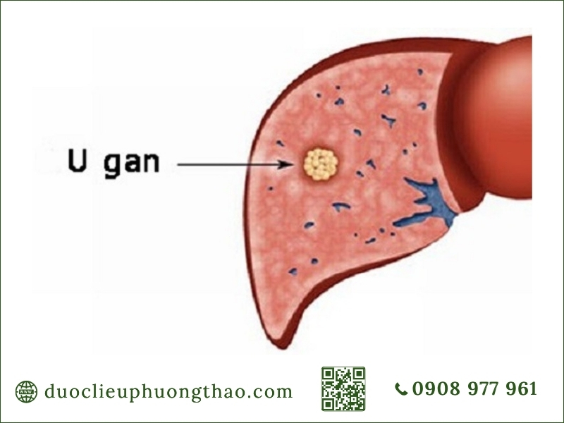u gan là gì