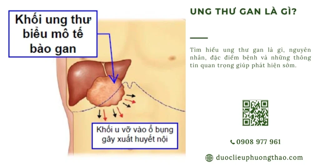 Ung thư gan là gì? Dấu hiệu, nguyên nhân và hướng xử trí