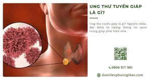 Ung thư tuyến giáp là gì? Nguyên nhân, triệu chứng và hướng điều trị phù hợp